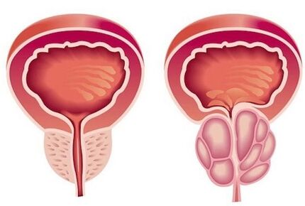 Síntomas de prostatite nos homes